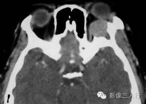 【病例】眼眶内皮样囊肿伴感染1例CT影像表现分析 【病例】眼眶内皮样囊肿伴感染1例CT影像表现分析