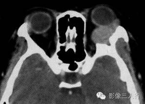 【病例】眼眶内皮样囊肿伴感染1例CT影像表现分析 【病例】眼眶内皮样囊肿伴感染1例CT影像表现分析