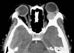 【病例】眼眶内皮样囊肿伴感染1例CT影像表现分析 【病例】眼眶内皮样囊肿伴感染1例CT影像表现分析