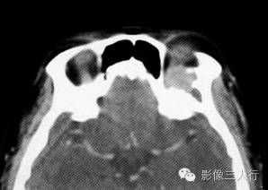 【病例】眼眶内皮样囊肿伴感染1例CT影像表现分析