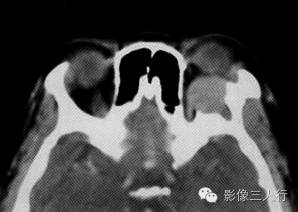 【病例】眼眶内皮样囊肿伴感染1例CT影像表现分析 【病例】眼眶内皮样囊肿伴感染1例CT影像表现分析