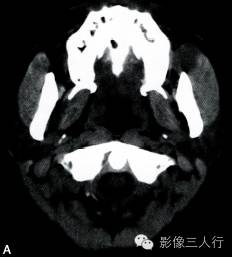 【病例】面颊部血管瘤1例CT影像表现 【病例】面颊部血管瘤1例CT影像表现