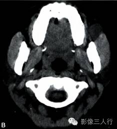 【病例】面颊部血管瘤1例CT影像表现 【病例】面颊部血管瘤1例CT影像表现