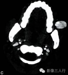 【病例】面颊部血管瘤1例CT影像表现