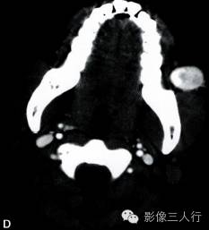 【病例】面颊部血管瘤1例CT影像表现 【病例】面颊部血管瘤1例CT影像表现