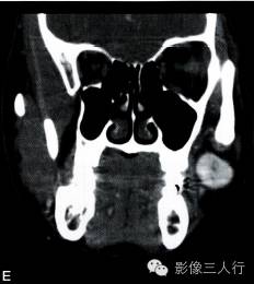 【病例】面颊部血管瘤1例CT影像表现 【病例】面颊部血管瘤1例CT影像表现