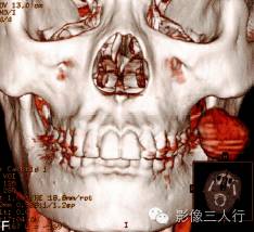 【病例】面颊部血管瘤1例CT影像表现 【病例】面颊部血管瘤1例CT影像表现