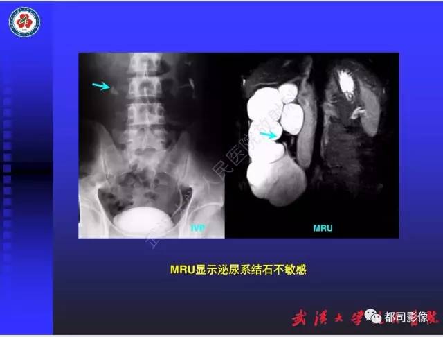 【PPT】泌尿系病变CT&MRI新技术及临床应用