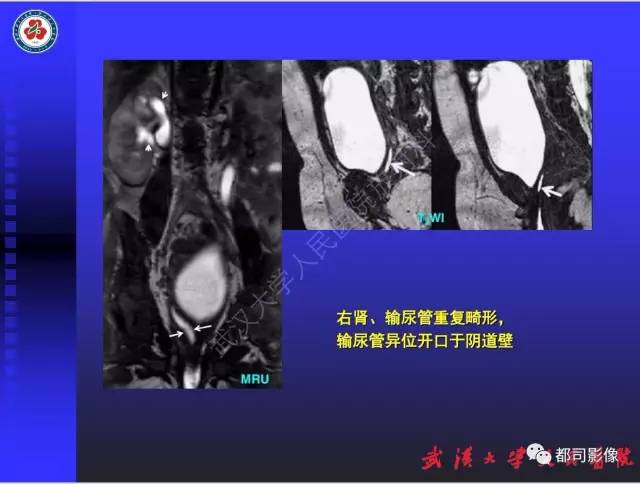 【PPT】泌尿系病变CT&MRI新技术及临床应用