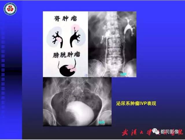 【PPT】泌尿系病变CT&MRI新技术及临床应用