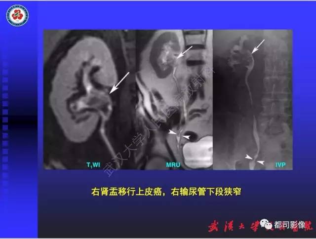 【PPT】泌尿系病变CT&MRI新技术及临床应用