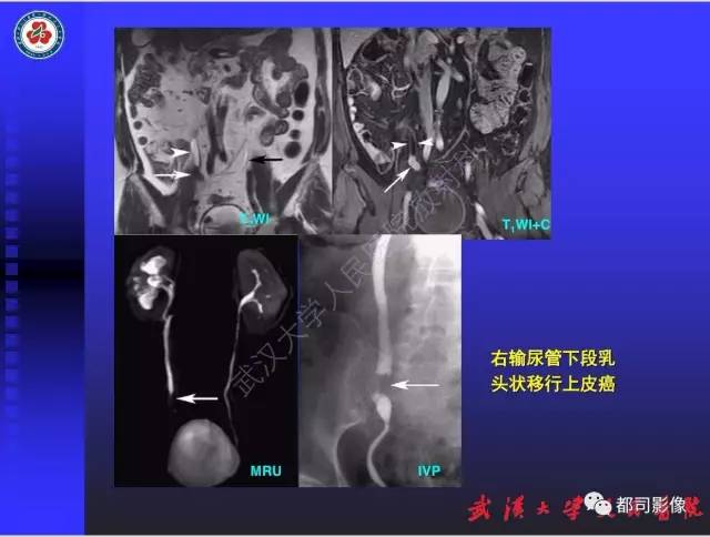 【PPT】泌尿系病变CT&MRI新技术及临床应用
