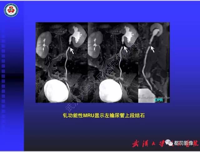 【PPT】泌尿系病变CT&MRI新技术及临床应用