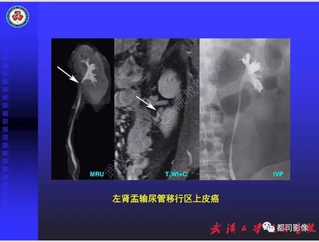 【PPT】泌尿系病变CT&MRI新技术及临床应用