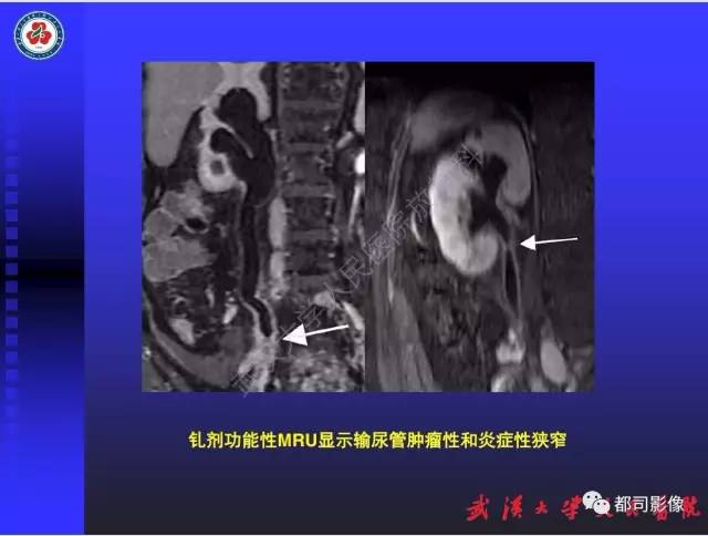 【PPT】泌尿系病变CT&MRI新技术及临床应用