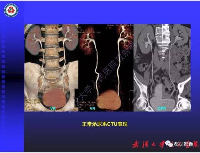 【PPT】泌尿系病变CT&MRI新技术及临床应用