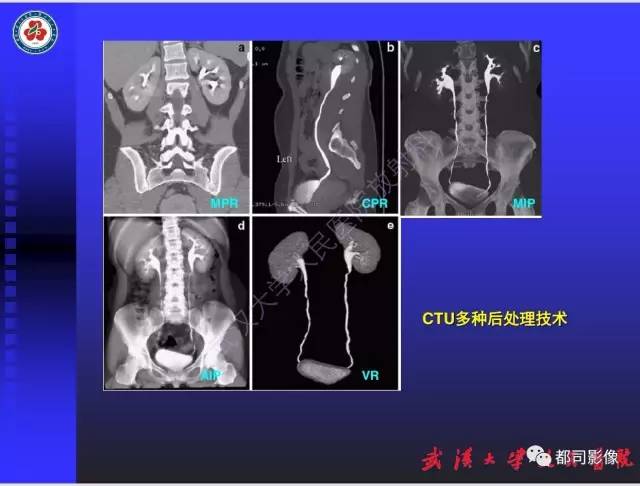 【PPT】泌尿系病变CT&MRI新技术及临床应用
