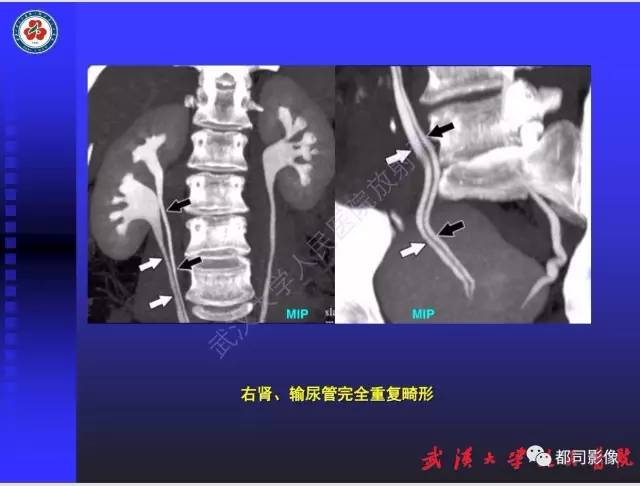 【PPT】泌尿系病变CT&MRI新技术及临床应用