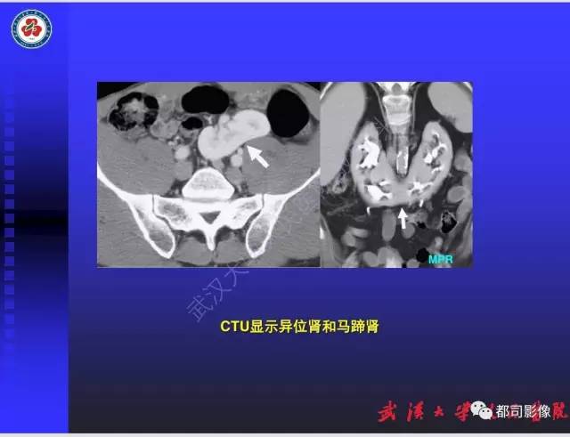 【PPT】泌尿系病变CT&MRI新技术及临床应用