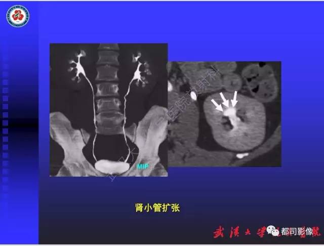 【PPT】泌尿系病变CT&MRI新技术及临床应用