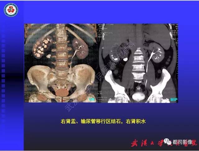 【PPT】泌尿系病变CT&MRI新技术及临床应用