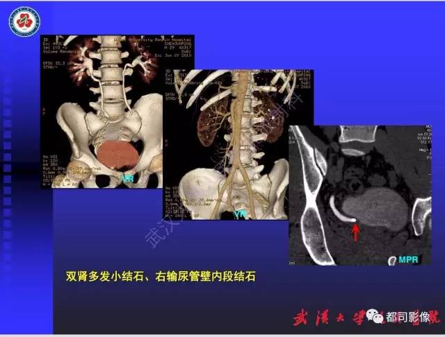 【PPT】泌尿系病变CT&MRI新技术及临床应用