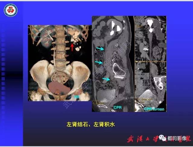 【PPT】泌尿系病变CT&MRI新技术及临床应用