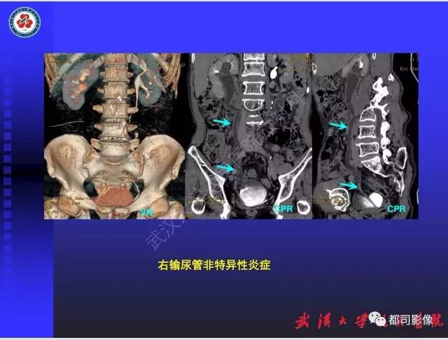 【PPT】泌尿系病变CT&MRI新技术及临床应用