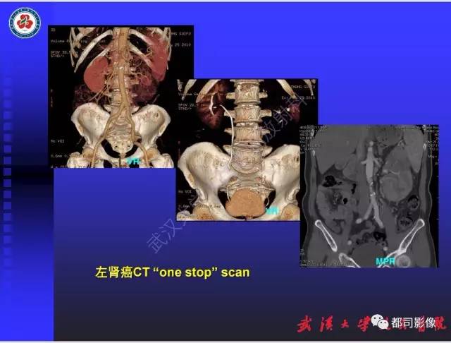 【PPT】泌尿系病变CT&MRI新技术及临床应用