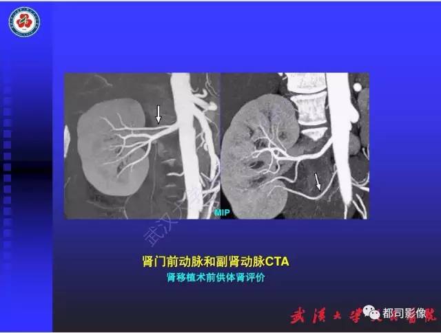 【PPT】泌尿系病变CT&MRI新技术及临床应用