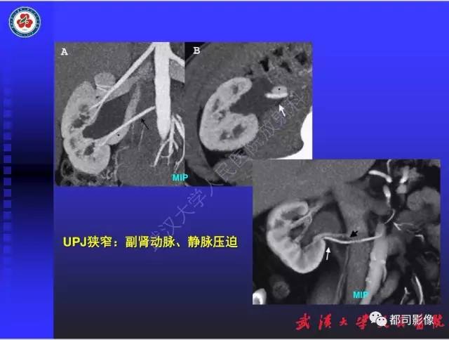 【PPT】泌尿系病变CT&MRI新技术及临床应用
