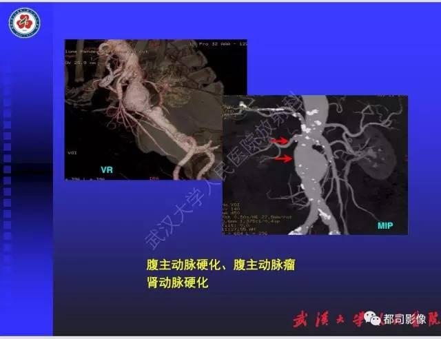 【PPT】泌尿系病变CT&MRI新技术及临床应用