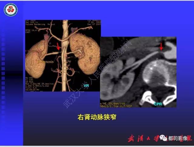 【PPT】泌尿系病变CT&MRI新技术及临床应用