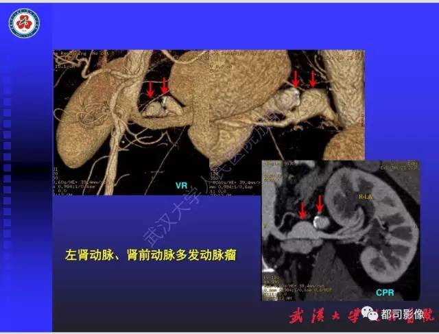 【PPT】泌尿系病变CT&MRI新技术及临床应用