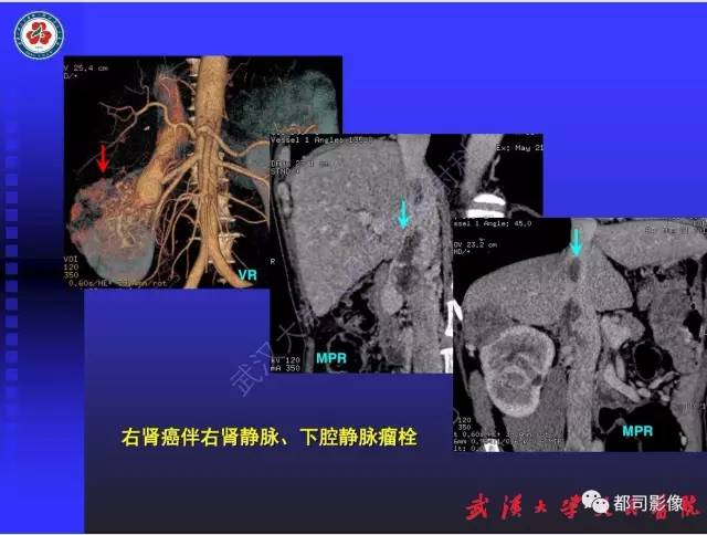 【PPT】泌尿系病变CT&MRI新技术及临床应用