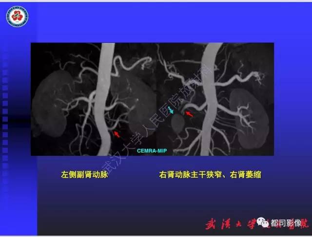 【PPT】泌尿系病变CT&MRI新技术及临床应用