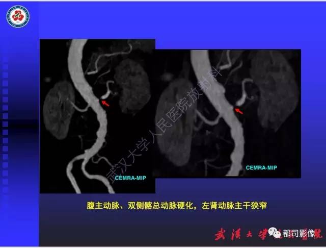 【PPT】泌尿系病变CT&MRI新技术及临床应用