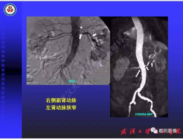 【PPT】泌尿系病变CT&MRI新技术及临床应用