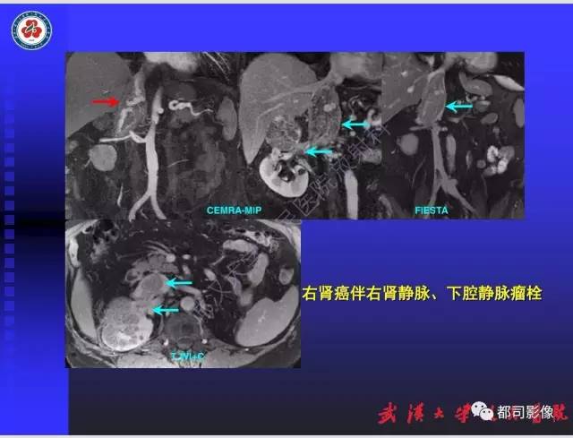 【PPT】泌尿系病变CT&MRI新技术及临床应用