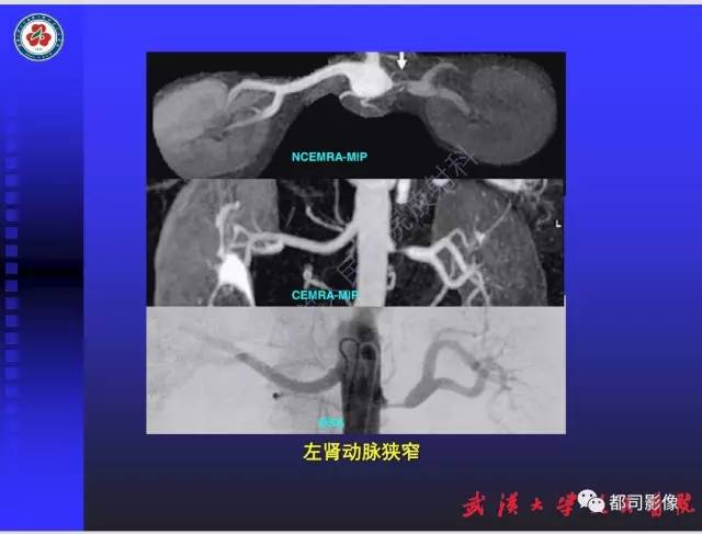 【PPT】泌尿系病变CT&MRI新技术及临床应用