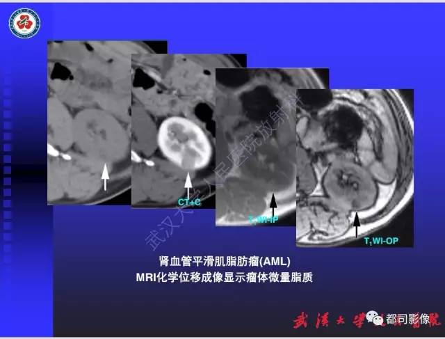 【PPT】泌尿系病变CT&MRI新技术及临床应用