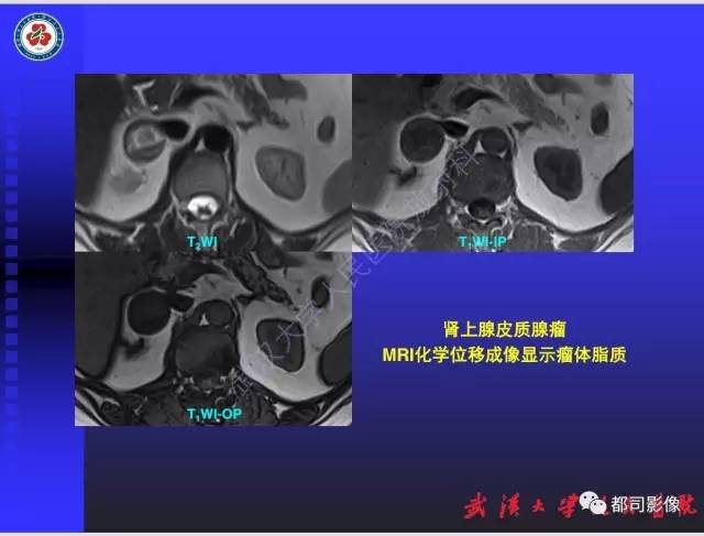 【PPT】泌尿系病变CT&MRI新技术及临床应用