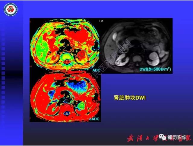 【PPT】泌尿系病变CT&MRI新技术及临床应用