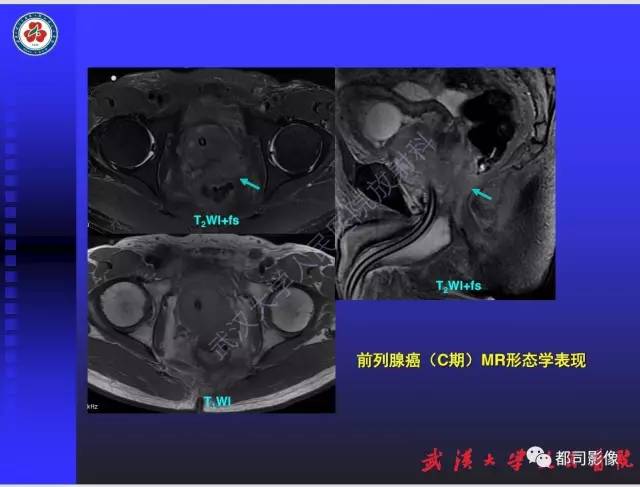 【PPT】泌尿系病变CT&MRI新技术及临床应用
