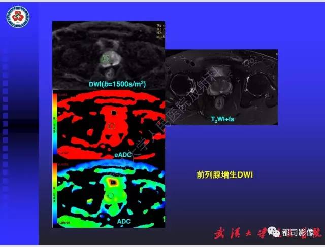 【PPT】泌尿系病变CT&MRI新技术及临床应用