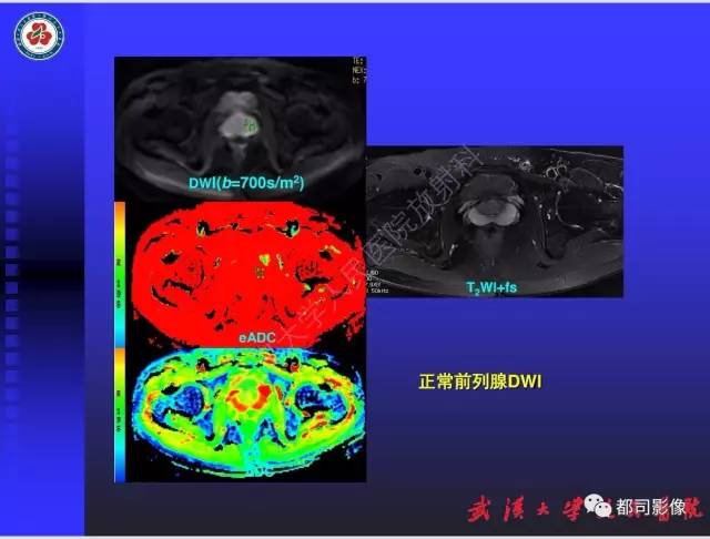 【PPT】泌尿系病变CT&MRI新技术及临床应用