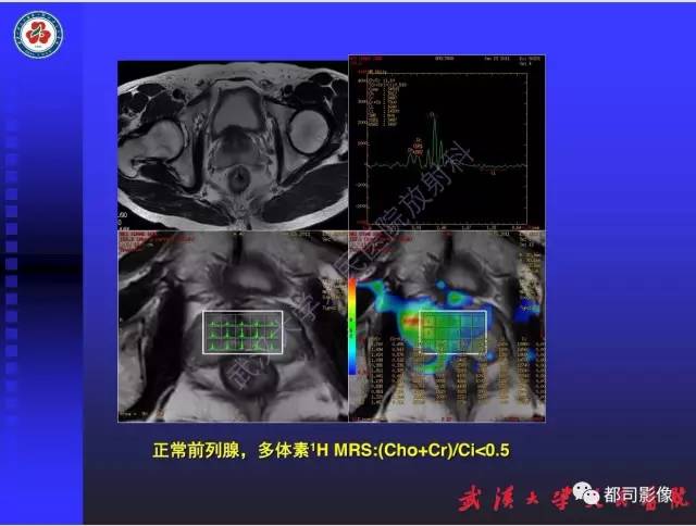 【PPT】泌尿系病变CT&MRI新技术及临床应用