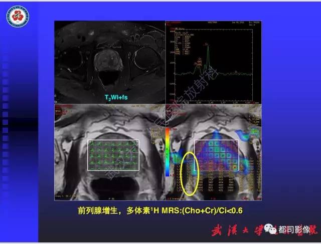【PPT】泌尿系病变CT&MRI新技术及临床应用