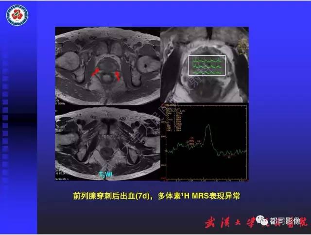【PPT】泌尿系病变CT&MRI新技术及临床应用