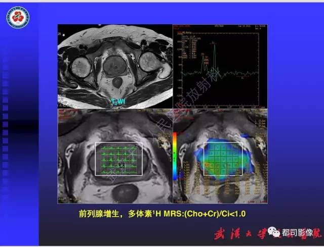 【PPT】泌尿系病变CT&MRI新技术及临床应用